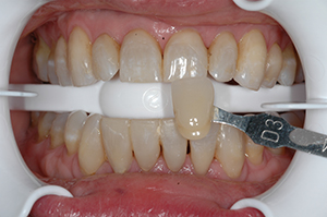 Bleaching_Before